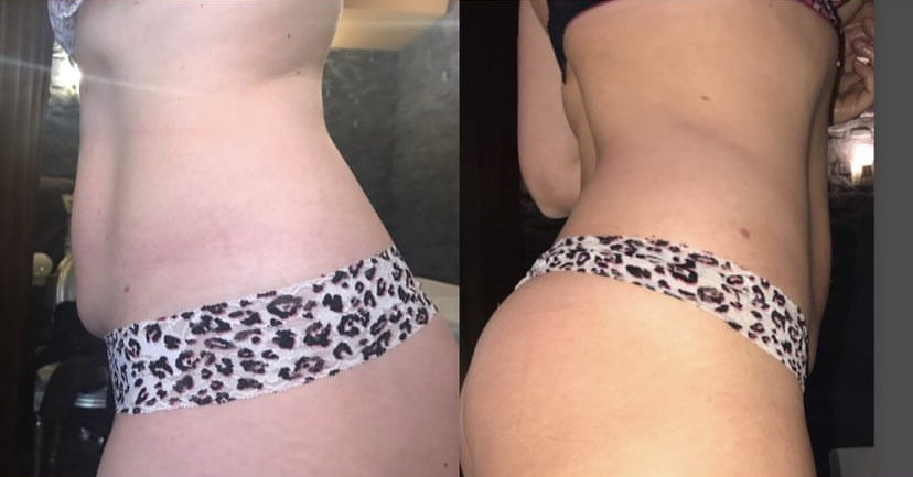 Skockica paket - maderoterapija cijelo tijelo - Fabrika ljepote, Sarajevo Anticelulit masaža Masaža Anticelulit masaža, Sarajevo, Istočno Sarajevo