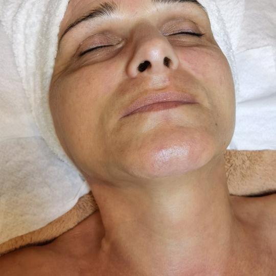 Deiva Allure #sarajevo Tretman lica Glow Peel