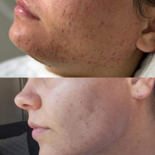 Hanas Skin Centar #banjaluka Tretman lica Hemijski piling - akne