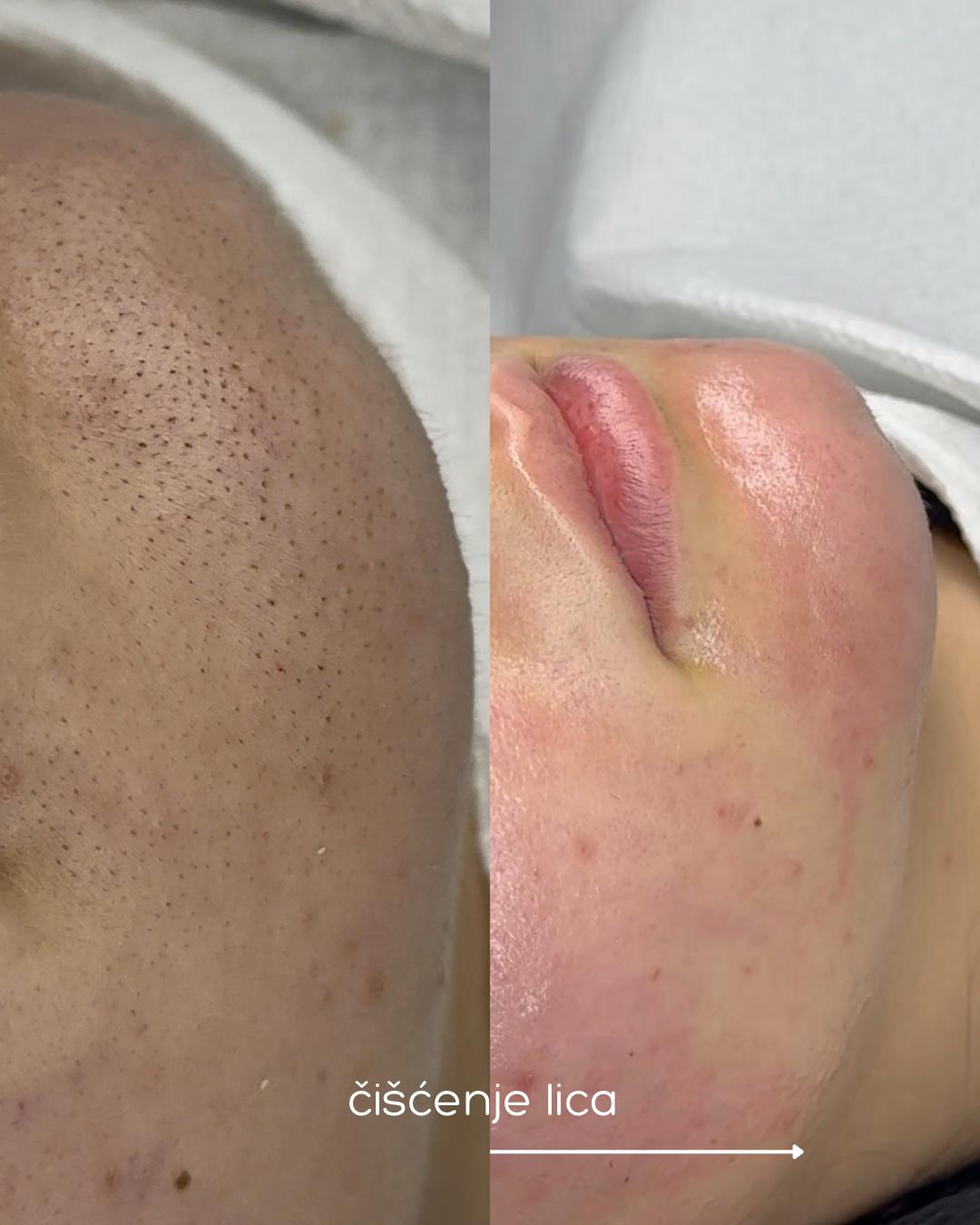 Hanas Skin Centar #banjaluka Air brush potamnjivanje kože Klasično higijensko čišćenje lica