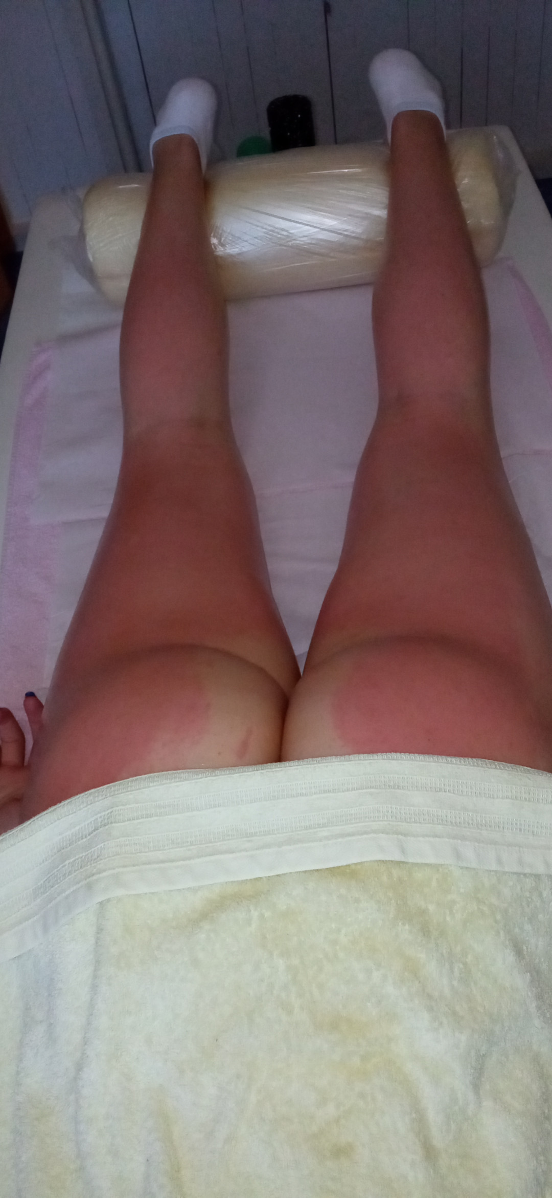 Nervus #banjaluka Anticelulit masaža Anticelulit masaža