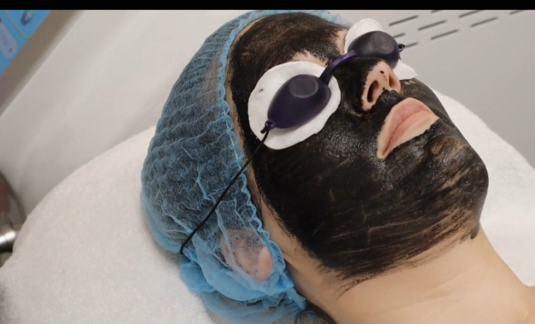 Sandra #visoko Tretman lica Carbon laser lice + vrat