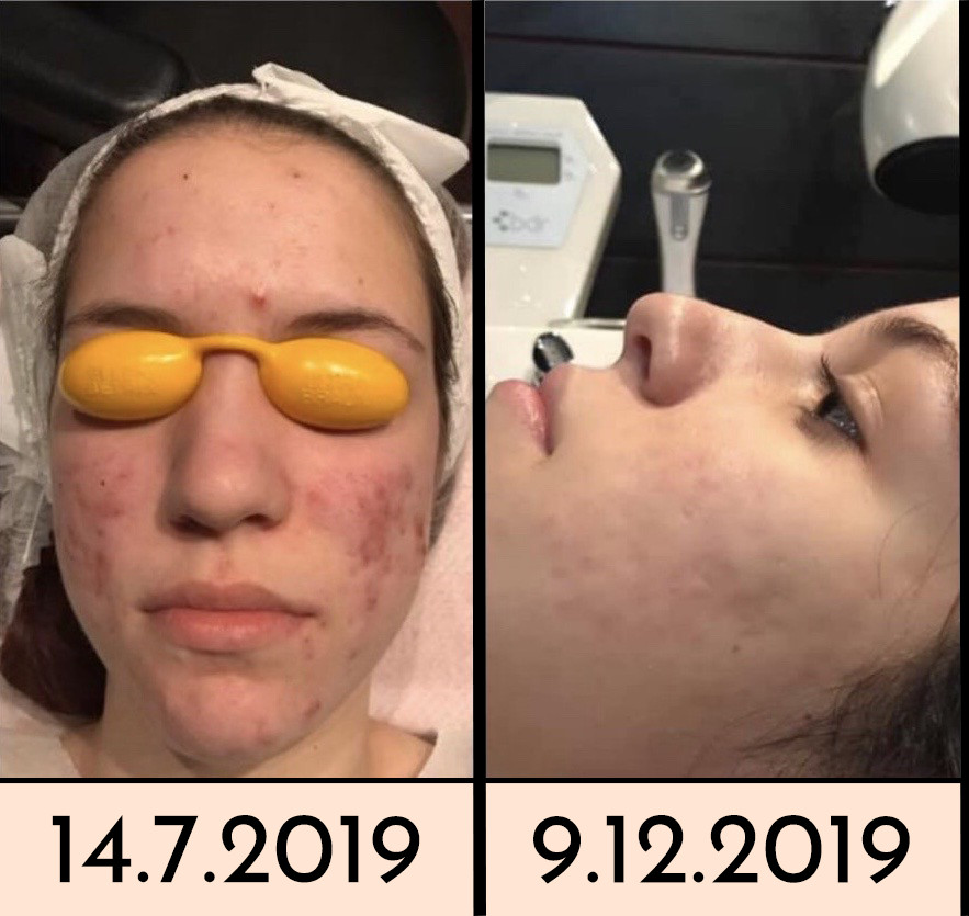 Vedrana #sarajevo Mikrodermoabrazija