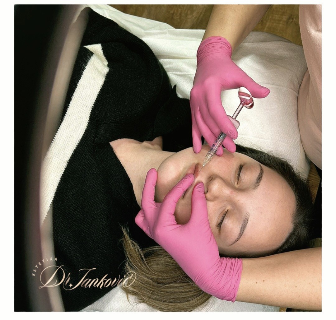 Estetika Janković #banjaluka Tretman lica Hijaluronski filer - 1 ml