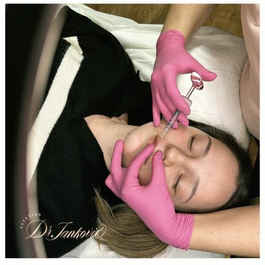 Estetika Janković #banjaluka Tretman lica Hijaluronski filer - 1 ml