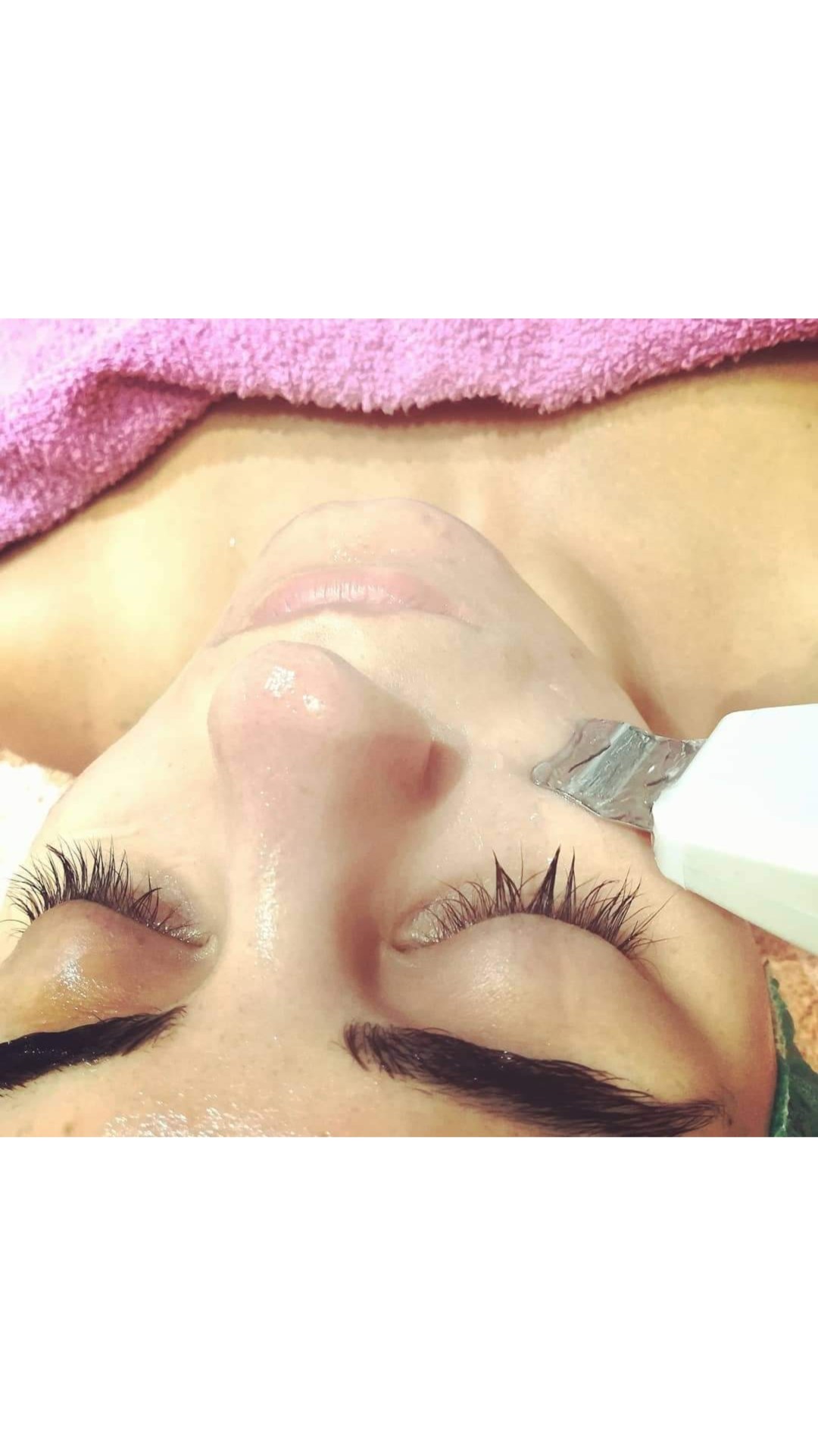 ABC Cosmetic #sarajevo Tretman lica Ultrazvučno čišćenje lica