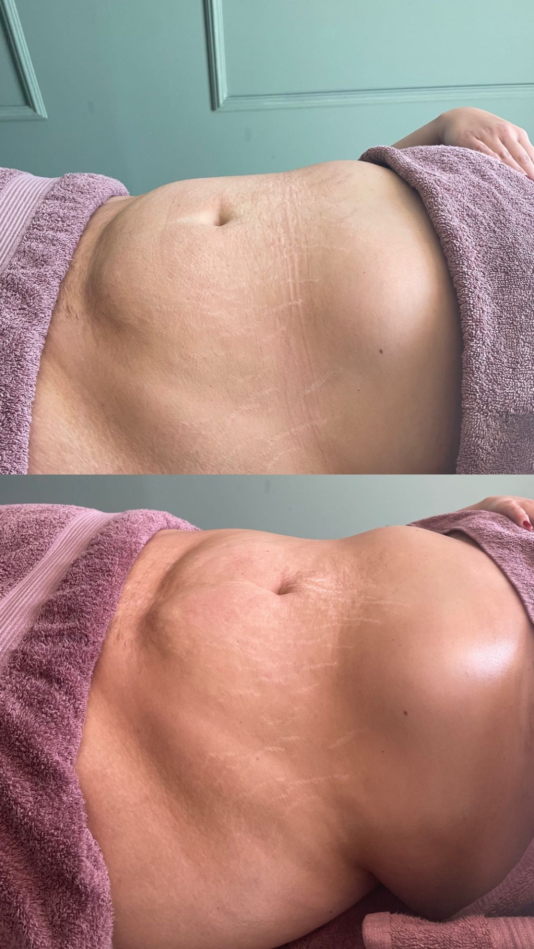 Limfomodelovanje - cijelo tijelo - Shine, Sarajevo Tretmani tijela Tijelo Tretmani tijela, Sarajevo, Novo Sarajevo - Novi Grad