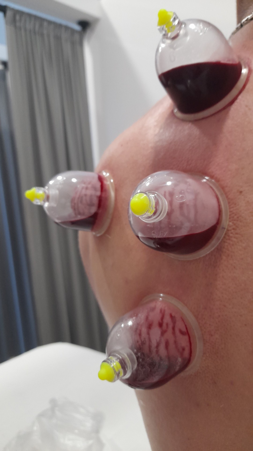 Salus #sarajevo Opšta masaža Hidžama + masaža