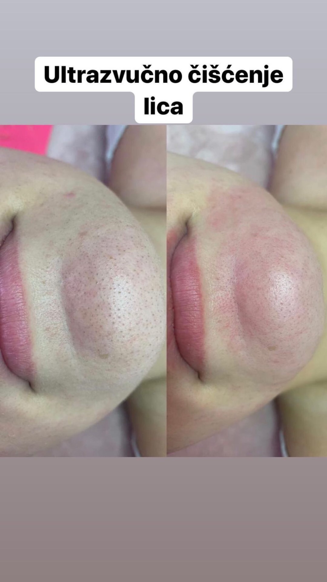 Damen #sarajevo Depilacija voskom Enzimski piling + ultrazvučno ćišćenje lica + vitamin C / kologen / hijaluron