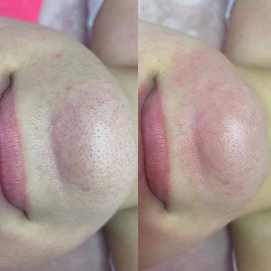 Damen #sarajevo Depilacija voskom Enzimski piling + ultrazvučno ćišćenje lica + vitamin C / kolo