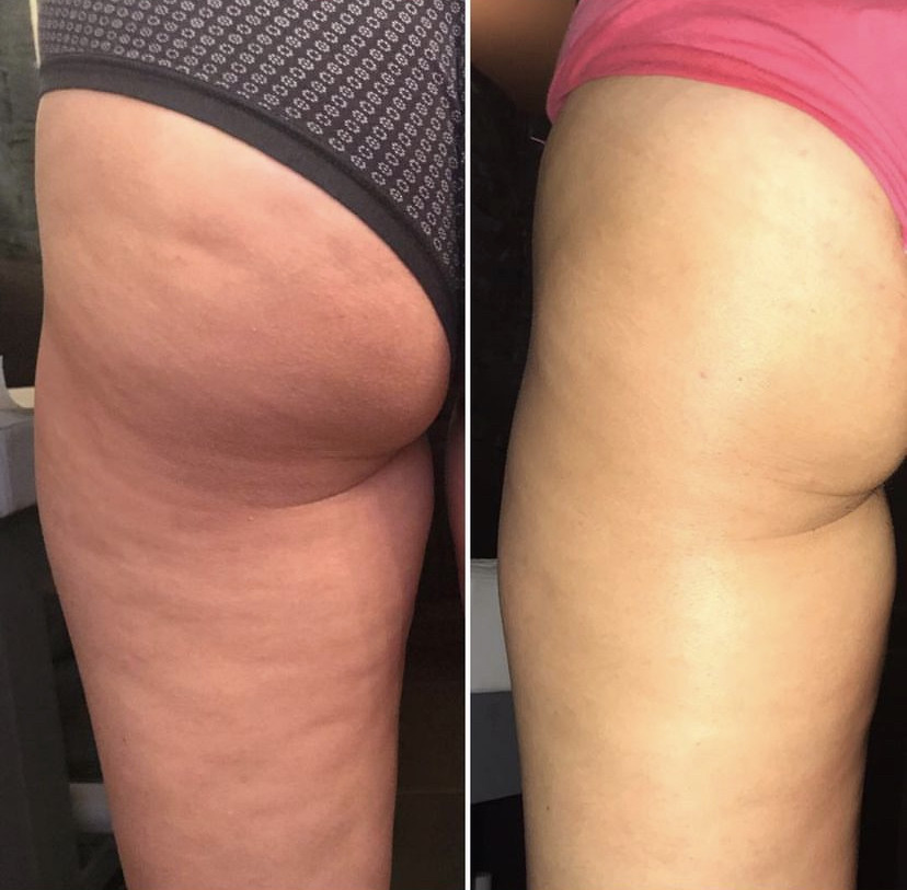 Skockica paket - maderoterapija cijelo tijelo - Fabrika ljepote, Sarajevo Anticelulit masaža Masaža Anticelulit masaža, Sarajevo, Istočno Sarajevo