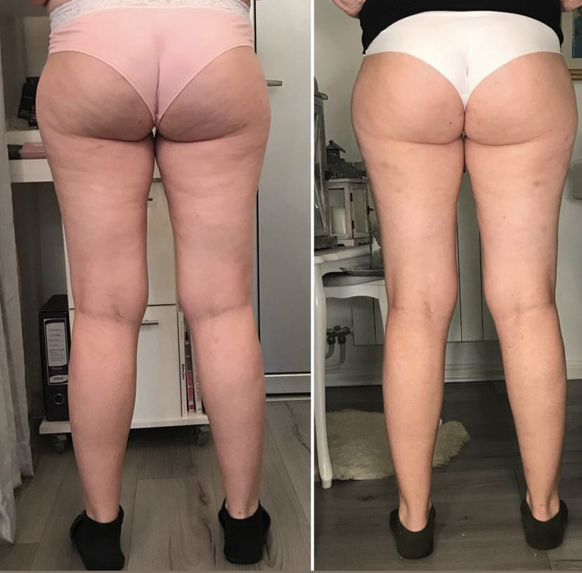 Skockica paket - maderoterapija noge + gluteus - Fabrika ljepote, Sarajevo Anticelulit masaža Masaža Anticelulit masaža, Sarajevo, Istočno Sarajevo