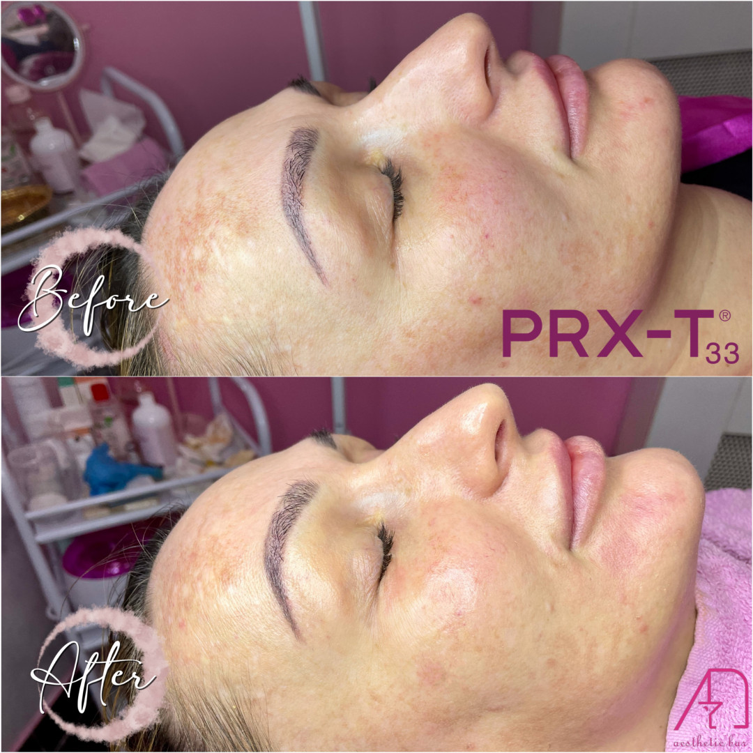 AEsthetic Bar Academy #sarajevo Botox PRX - T33 tretman lica
