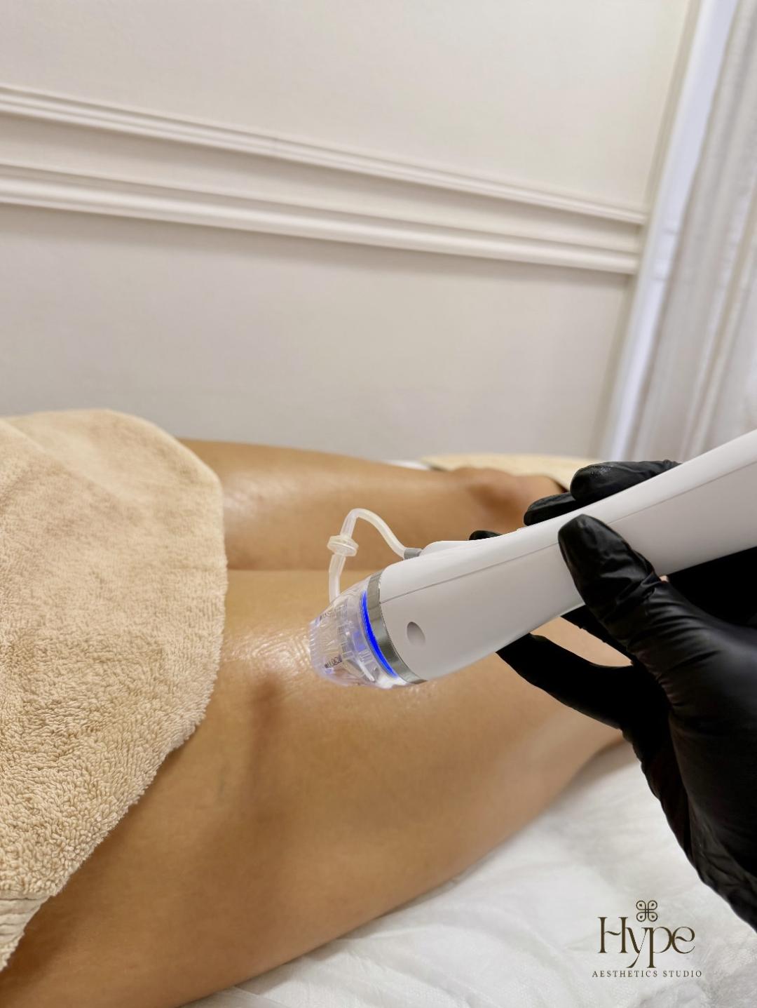 Hype Aesthetics Studio #sarajevo Tretmani tijela Rf microneedling - noge