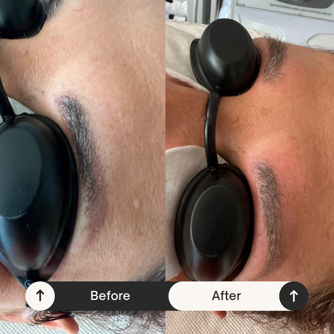 AEsthetic Bar Academy #sarajevo Make-up / šminkanje Lasersko uklanjanje permanent šminke / tetovaže