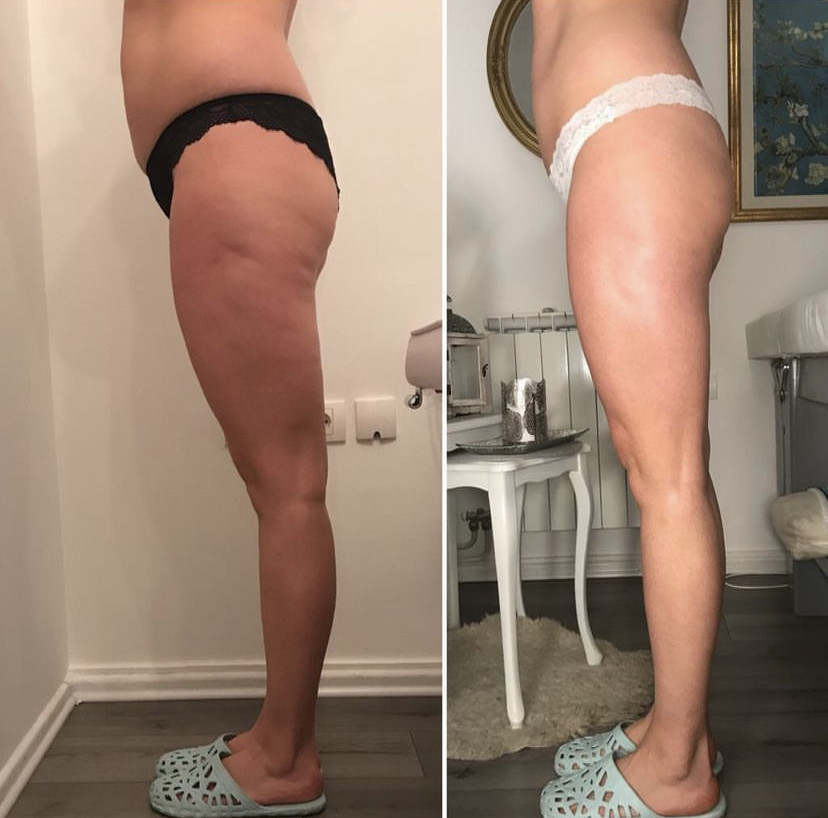 Skockica paket - maderoterapija noge + gluteus - Fabrika ljepote, Sarajevo Anticelulit masaža Masaža Anticelulit masaža, Sarajevo, Istočno Sarajevo