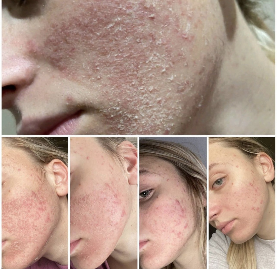 Dora Beauty #sarajevo Tretman lica Green sea peel tretman