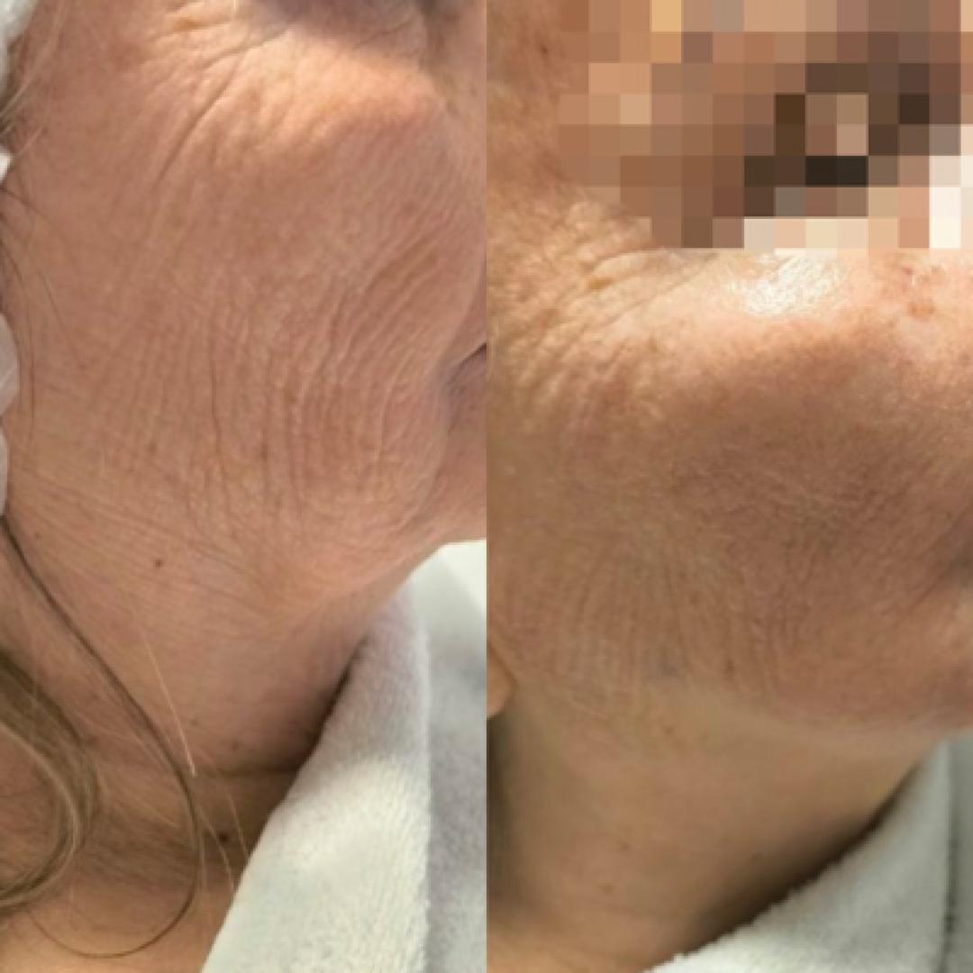 Biorevitalizacija lica -polinukleotidima - Estetika Janković, Banja Luka Tretman lica Lice Tretman lica, Banja Luka, Centar