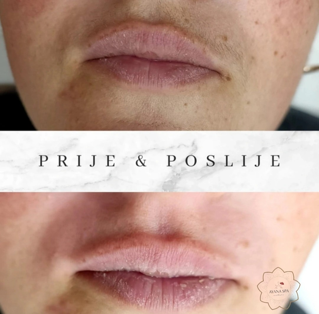 Ayana Spa #sarajevo Depilacija šećernom pastom Depilacija nausnica šećernom pastom - za dame