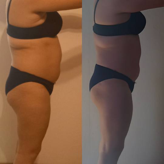 Madero Masaže #banjaluka Anticelulit masaža Maderoterapija + anticelulit masaža - noge + gluteus 