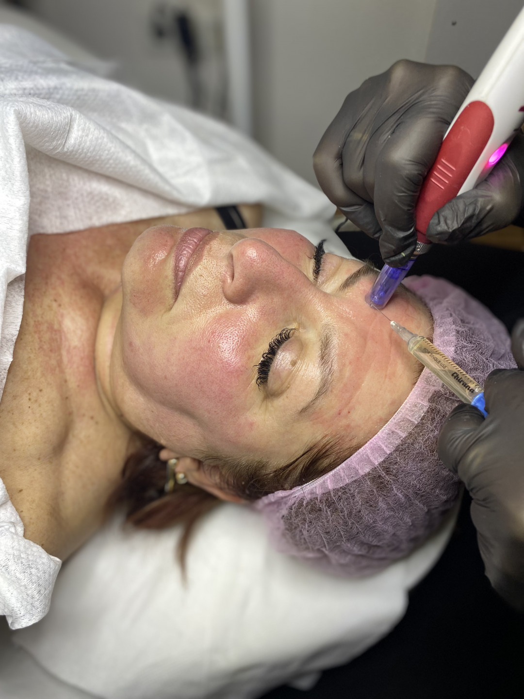 Senka #sarajevo Tretman lica Ciscenje lica sa ampulom