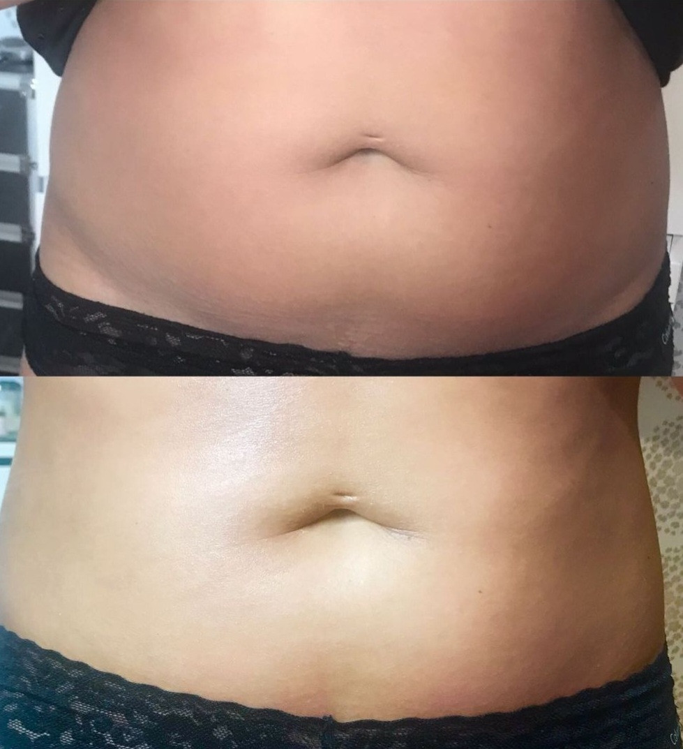 Sandra #visoko Tretmani tijela HIFU - stomak