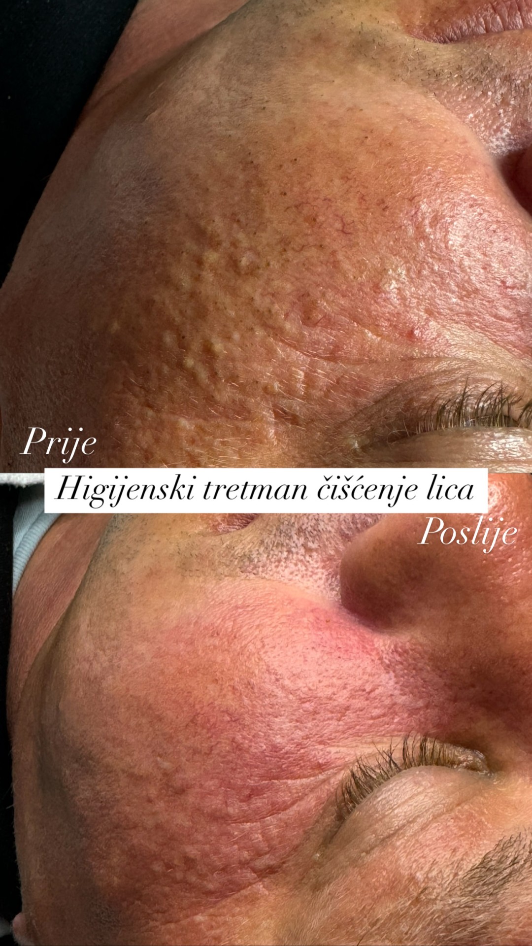 Allure #sarajevo Tretman lica Čišćenje lica