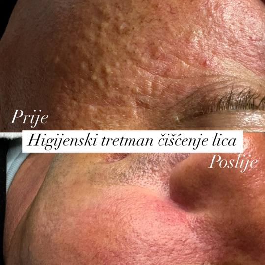 Allure #sarajevo Tretman lica Čišćenje lica