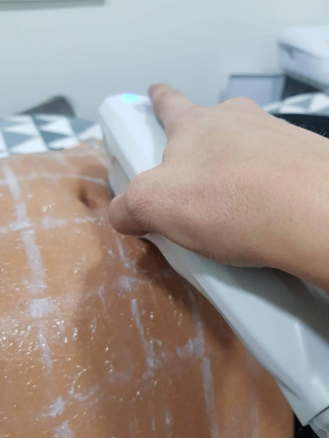 Sandra #visoko Tretmani tijela HIFU - stomak