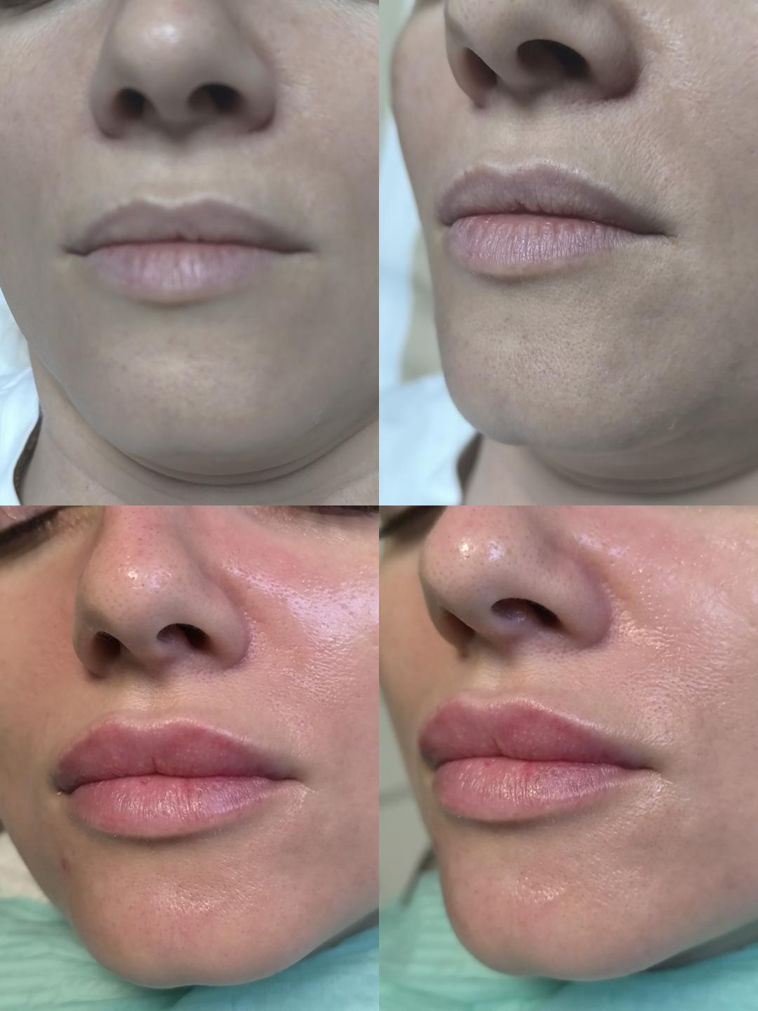 Hijaluronski filer - 1 ml - Estetika Janković, Banja Luka Tretman lica Lice Tretman lica, Banja Luka, Centar