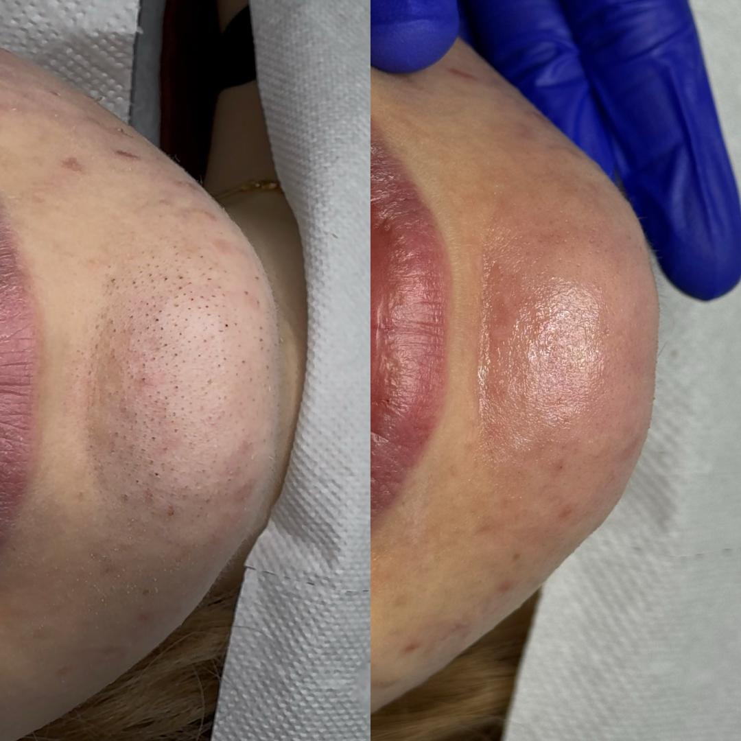 Hanas Skin Centar #banjaluka Air brush potamnjivanje kože Klasično higijensko čišćenje lica