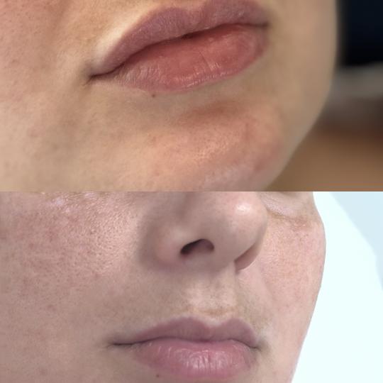 Estetika Janković #banjaluka Tretman lica Hijaluronski filer - 1 ml Korekcija usana hijaluronom