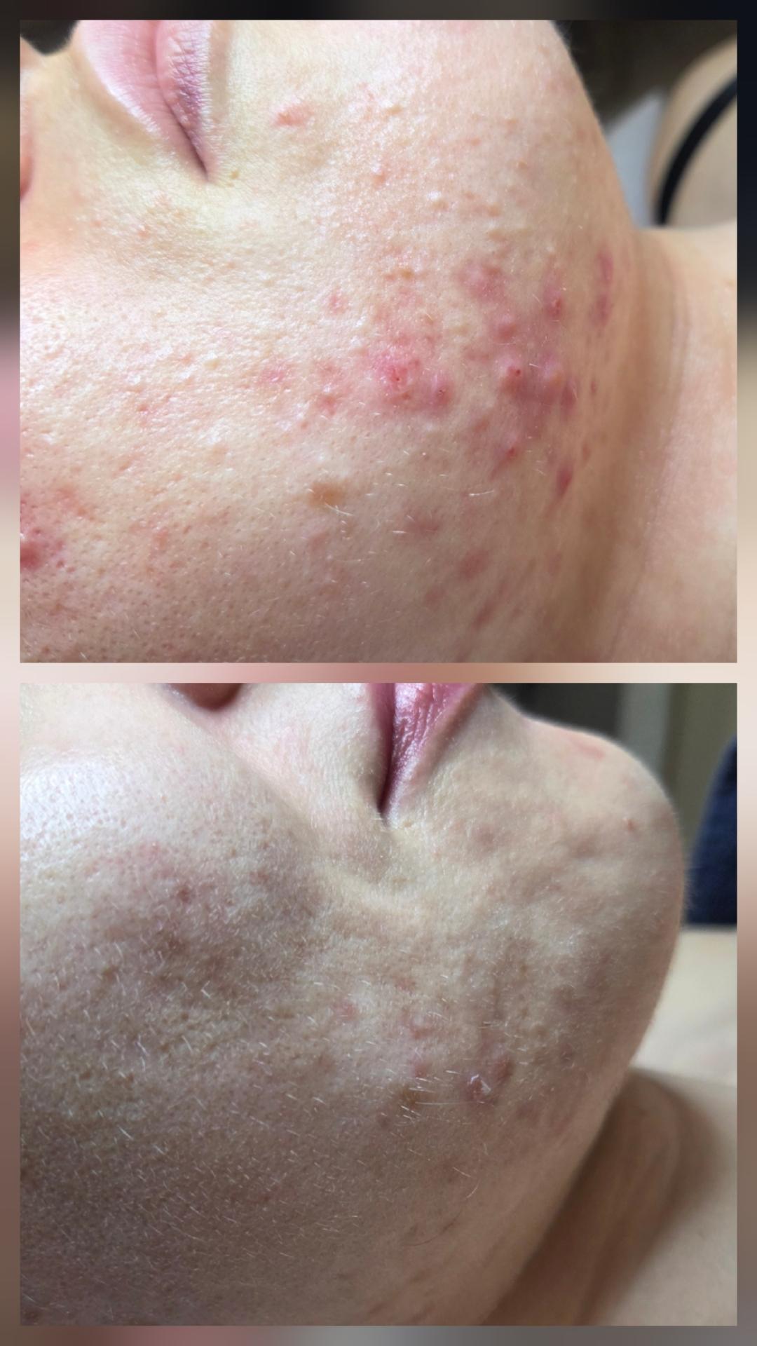 Hemijski piling lica - Angels Beauty - Banja Luka, Banja Luka Tretman lica Lice Tretman lica, Banja Luka, Centar