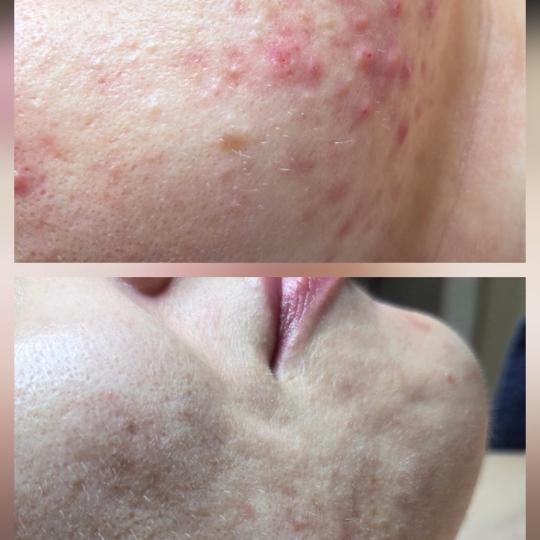 Angels Beauty - Banja Luka #banjaluka Tretman lica Hemijski piling lica Rezultati nakon mjesec dana 