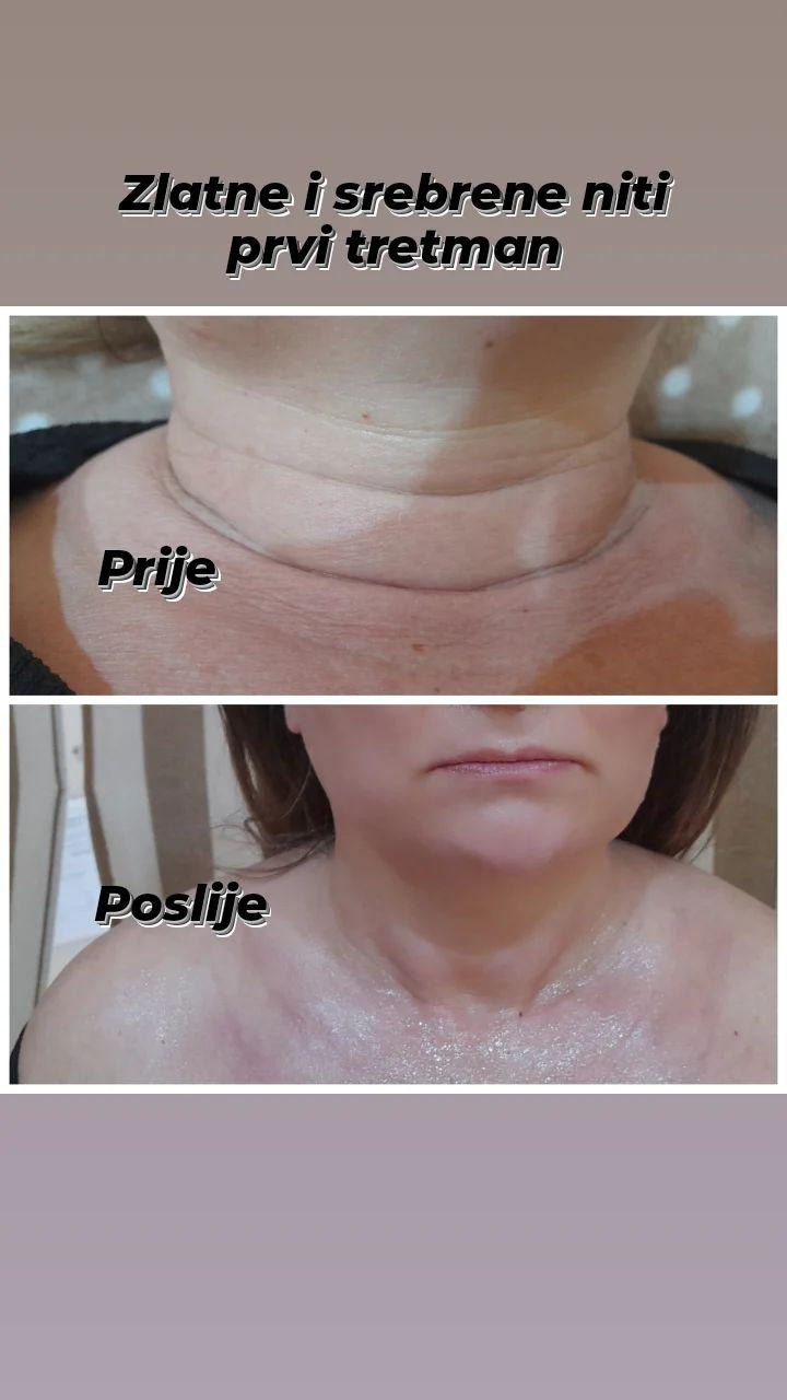 Tretman srebrnim + zlatnim nitima - lice + vrat + dekolte - Poezija ljepote, Sarajevo Tretman lica Lice Tretman lica, Sarajevo, Novo Sarajevo - Novi Grad