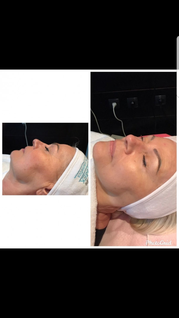 Vedrana #sarajevo Tretman lica