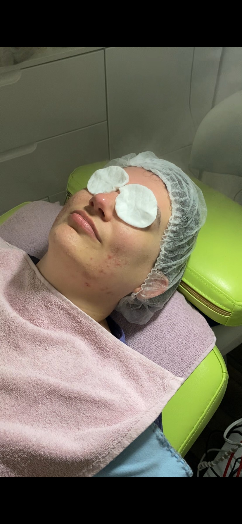 Beauty by Lara #sarajevo Tretman lica Medicinski tretman lica