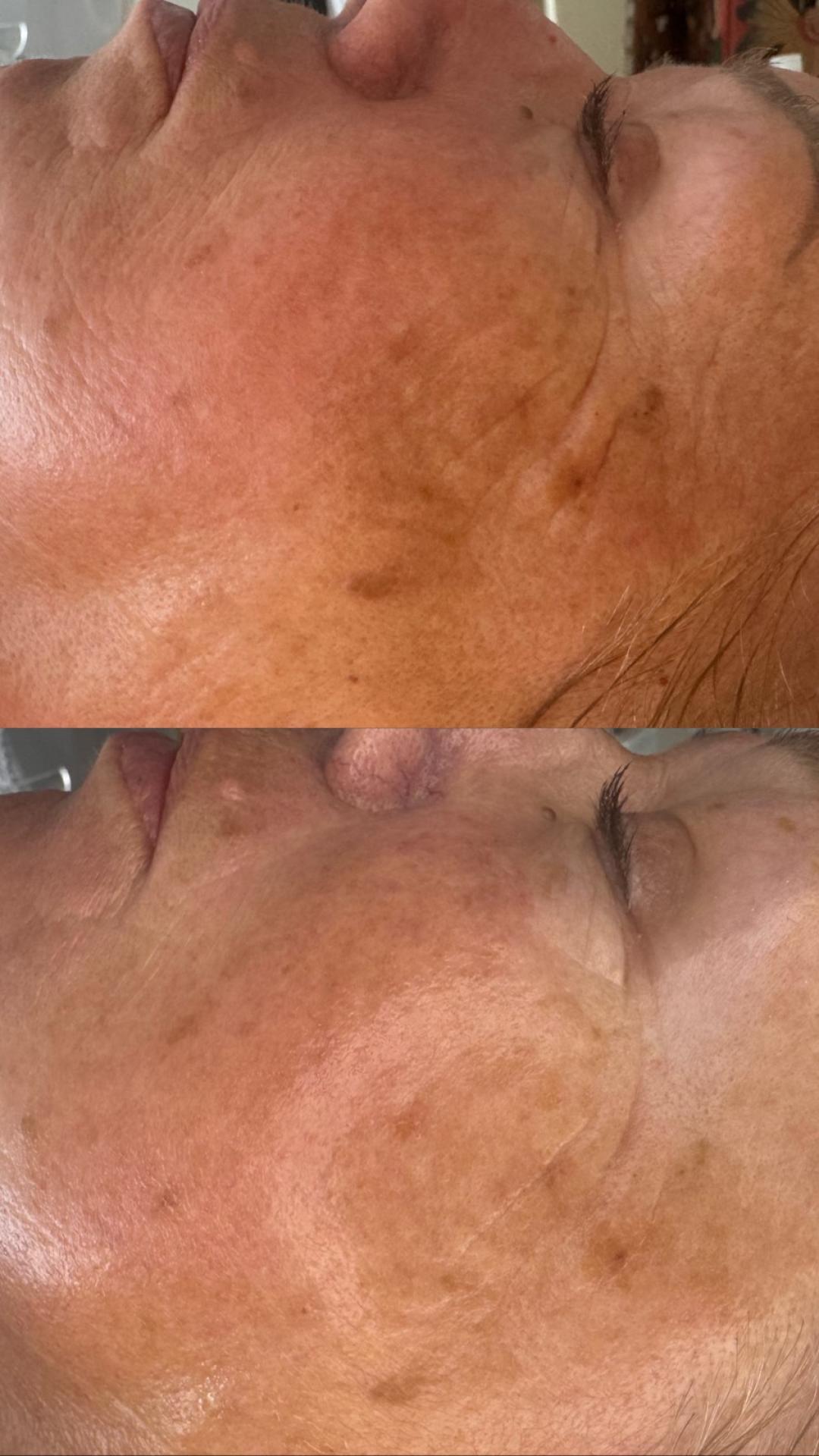Gaia beauty & beyond #banjaluka Mezoterapija lica BDR mezoterapija Age control superior