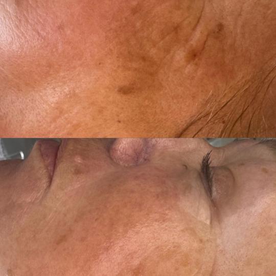 Gaia beauty & beyond #banjaluka Mezoterapija lica BDR mezoterapija Age control superior