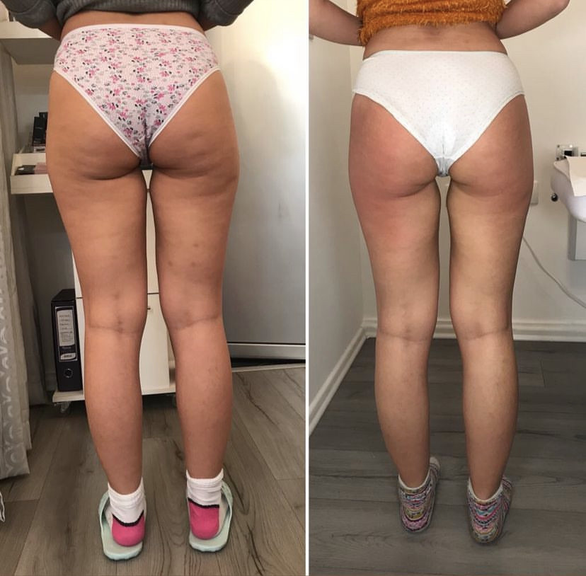 Skockica paket - maderoterapija noge + gluteus - Fabrika ljepote, Sarajevo Anticelulit masaža Masaža Anticelulit masaža, Sarajevo, Istočno Sarajevo