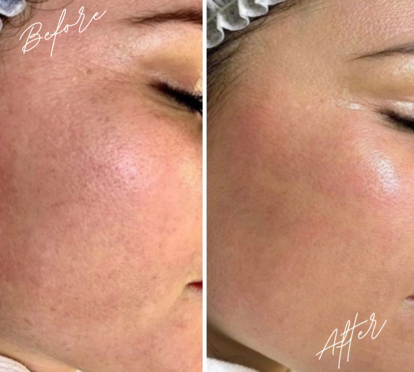 Beauty Studio Señorita #sarajevo Tretman lica Mikrodermoabrazija + Ultrazvučno hranjenje lica