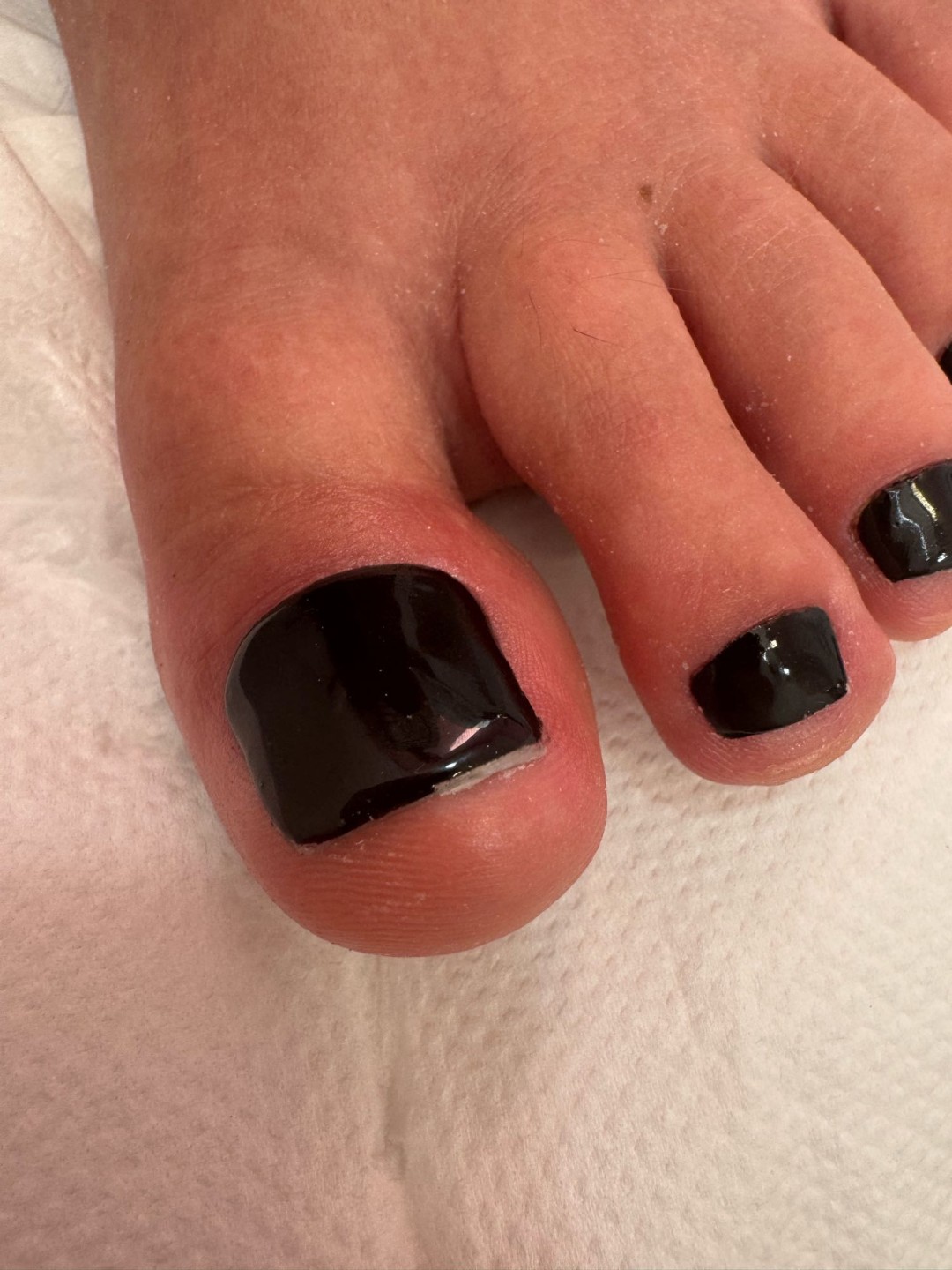 Fridem #banjaluka Medicinski pedikir Medicinski pedikir - oboljenje jednog nokta