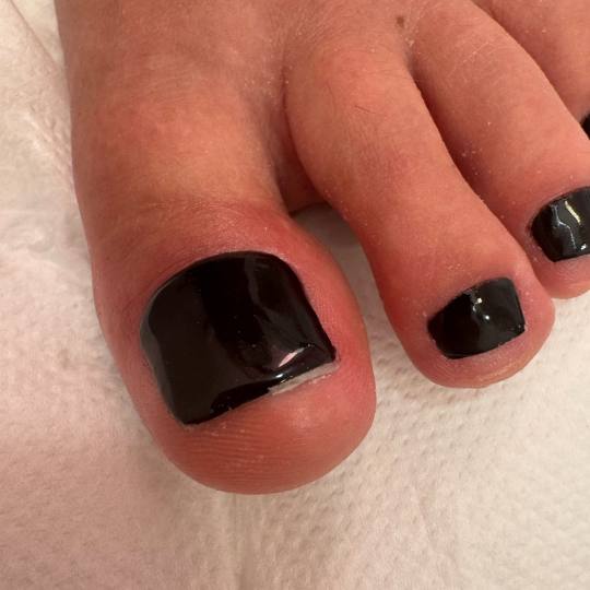 Fridem #banjaluka Medicinski pedikir Medicinski pedikir - oboljenje jednog nokta