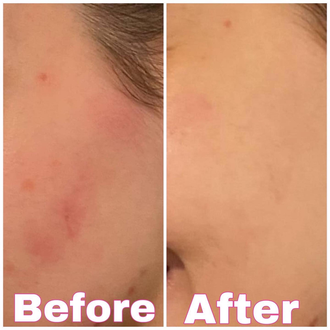 Microneedling - protiv akni i ožiljaka - AEsthetic Bar Academy, Sarajevo Tretman lica Lice Tretman lica, Sarajevo, Novo Sarajevo - Novi Grad