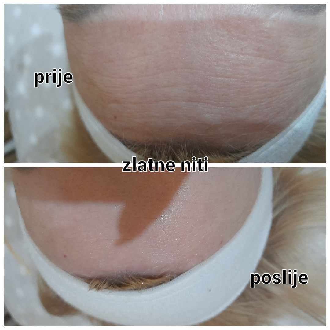 Tretman srebrnim + zlatnim nitima - lice + vrat + dekolte - Poezija ljepote, Sarajevo Tretman lica Lice Tretman lica, Sarajevo, Novo Sarajevo - Novi Grad