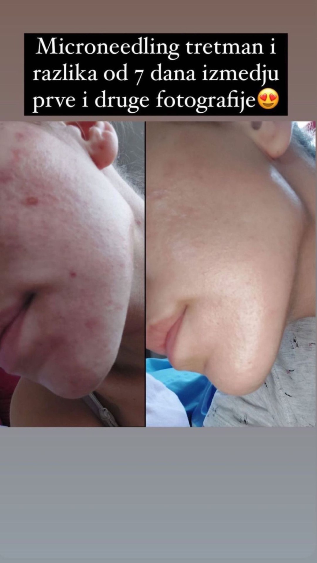 Damen #sarajevo Tretman lica Ultrazvučno čišćenje + microneedling tretman lica