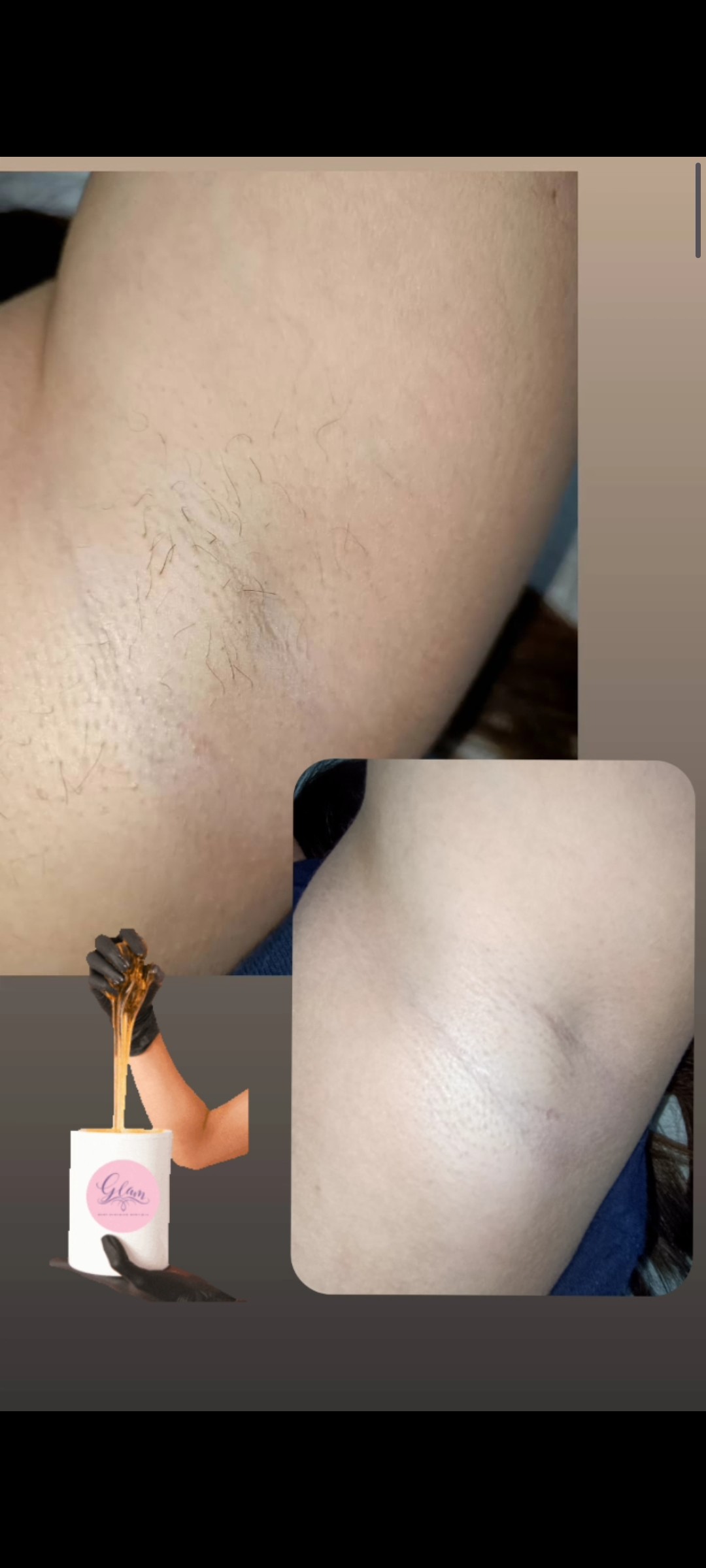 Ayana Spa #sarajevo Depilacija šećernom pastom Depilacija pazuha šećernom pastom - za dame