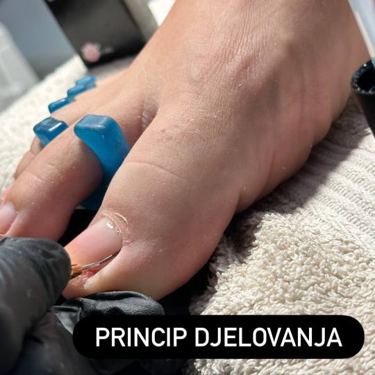 Uljepšaj se #sarajevo Medicinski pedikir Liftup gel - urasli nokat