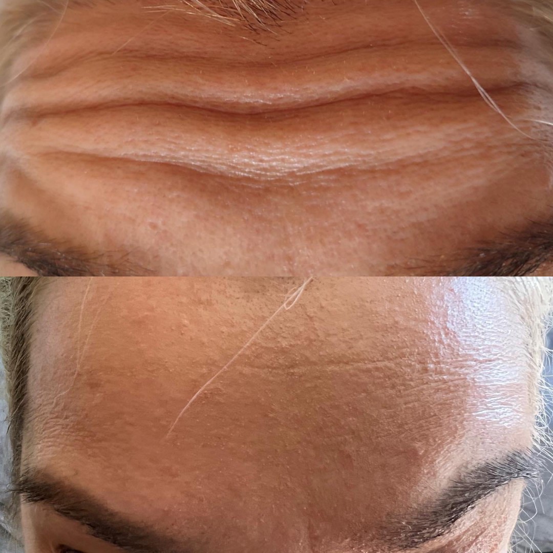 Signature #tuzla Tretmani protiv bora Edukacija - popunjavanje bora / povećanje volumena usana bez igle