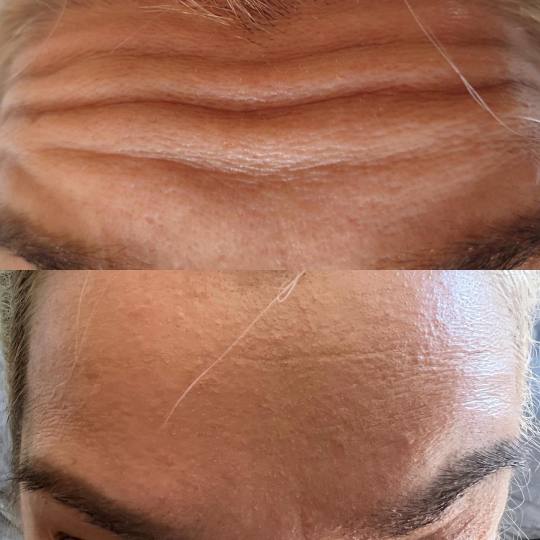 Signature #tuzla Tretmani protiv bora Edukacija - popunjavanje bora / povećanje volumena usana bez 